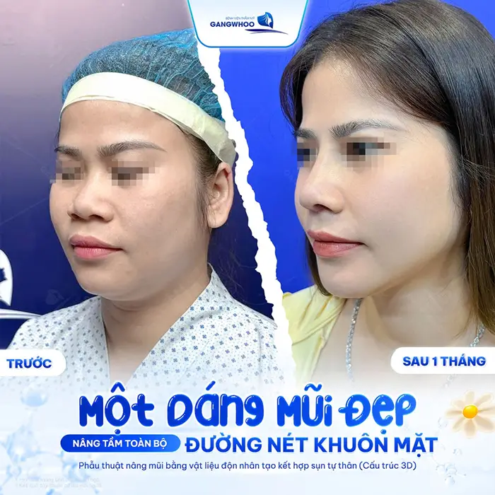 1 dáng mũi đẹp nâng tầm đường nét diện mạo thêm bừng sức sống