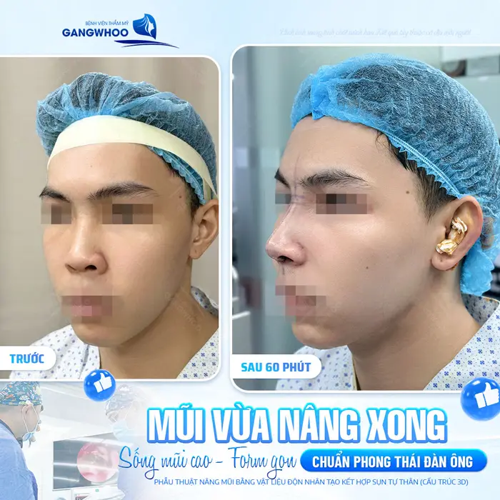 Phẫu thuật nâng mũi kiến tạo nét đẹp chuẩn phong thái đàn ông tôn diện mạo đẹp chuẩn cho nam giới