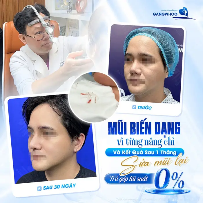 Mũi biến dạng vì từng nâng chỉ và kết quả sau 1 tháng sửa mũi lại 