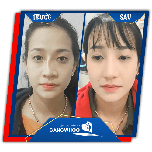 Images of customers before & after rhinoplasty, nose revision at Gangwhoo Cosmetic Hospital