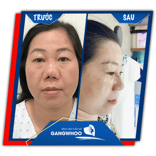 Images of our customers before & after nose revision at Gangwhoo Cosmetic Hospital