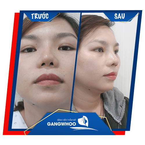 Images of our customers & after nose revision at Gangwhoo Cosmetic Hospital