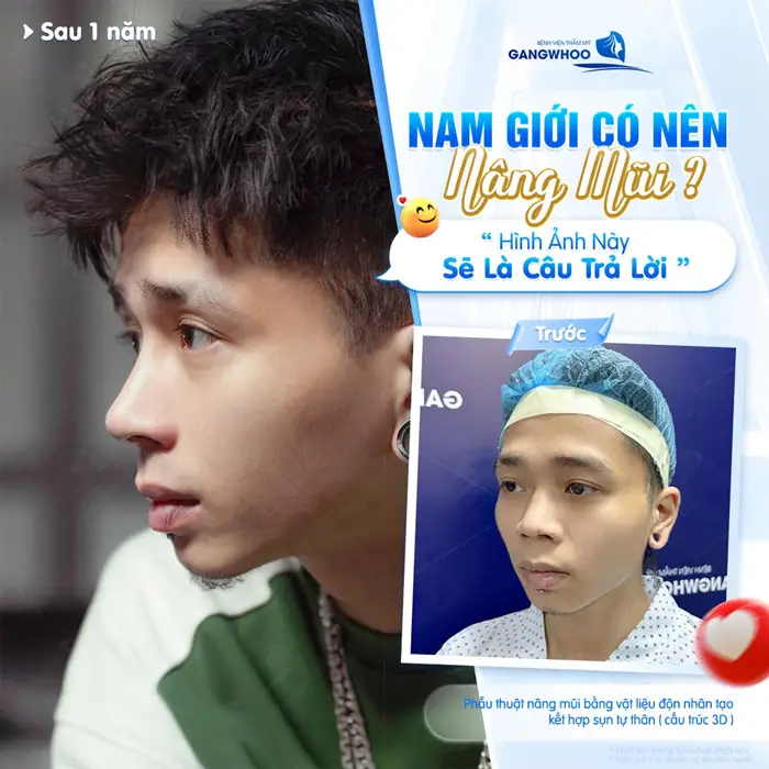 Nam giới nâng mũi thay đổi thần thái, bừng sáng gương mặt thêm cuốn hút và đầy ấn tượng