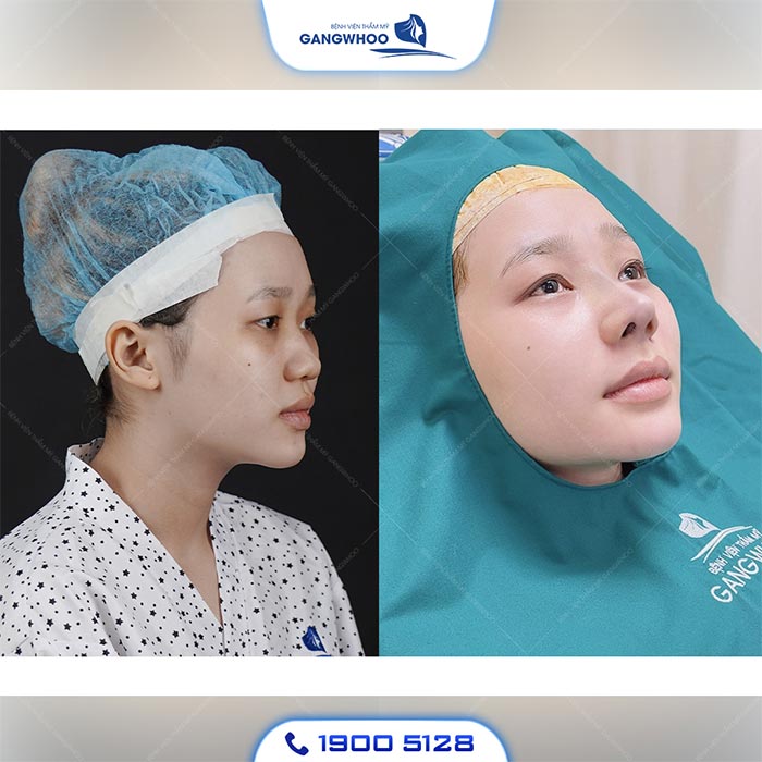 Dậy Thì Có Làm Mũi Cao Lên Không? 8 Cách Làm Mũi Cao 15 Dậy Thì Có Làm Mũi Cao Lên Không
