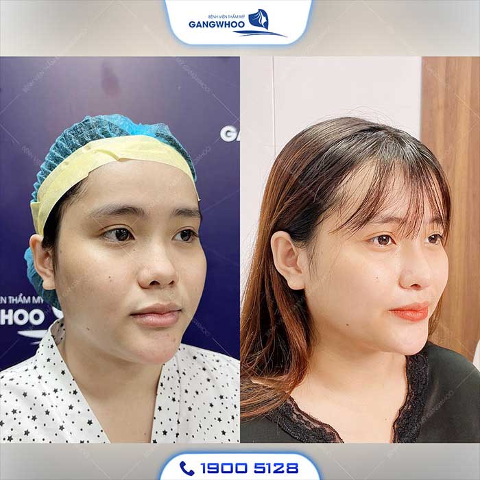 Nâng Mũi Bằng Chỉ Được Bao Lâu? Những Lưu Ý Để Duy Trì Lâu Dài 5 Hình ảnh khách hàng da mũi mỏng thực hiện nâng mũi