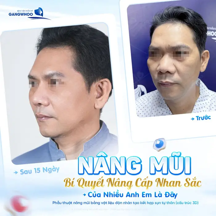 Nâng mũi bí quyết giúp nâng cấp nhan sắc của nhiều anh em 