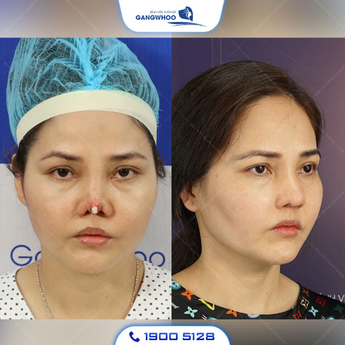 Nâng Mũi Bị Tụt Sụn