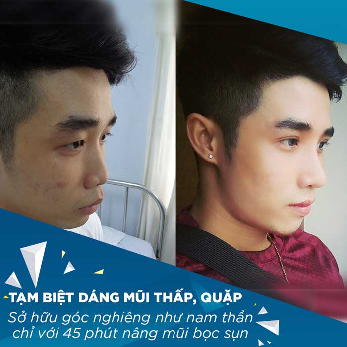 Images of our customers before & after rhinoplasty 