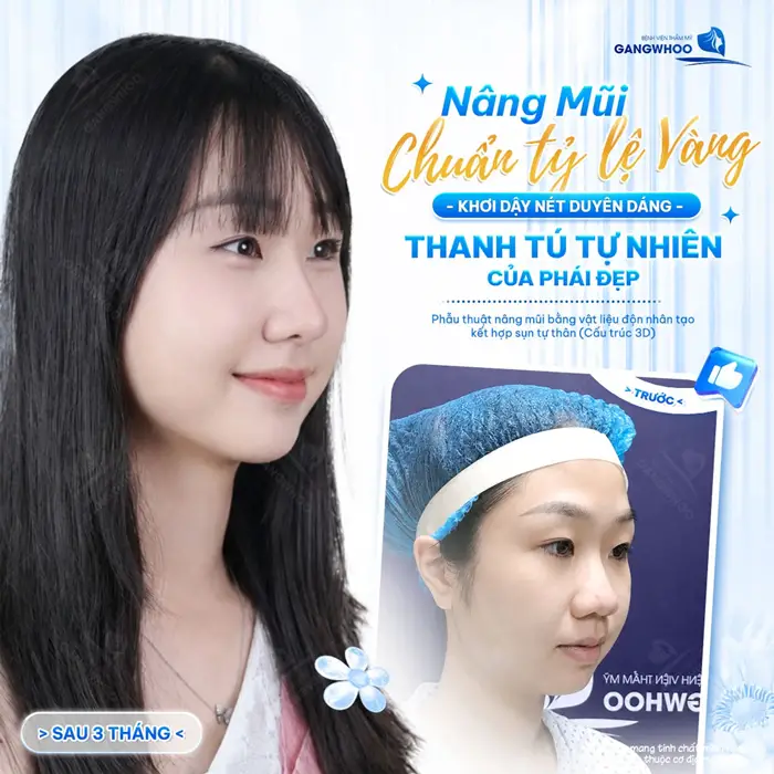 Nâng mũi chuẩn tỷ lệ vàng khơi dậy nét đẹp duyên dang cho gương mặt thêm thanh tú tự nhiên