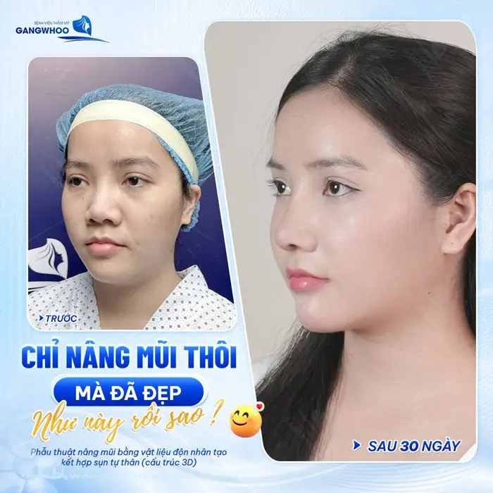 Thay đổi dáng mũi gương mặt thêm điểm nhấn, đường nét thêm thần thái và xinh tươi