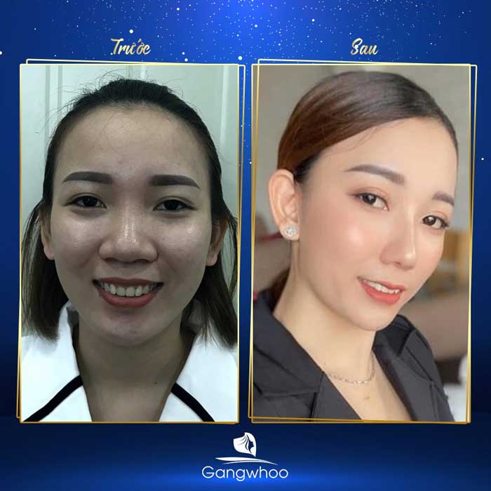 Images of our customers before & after cartilage rhinoplasty