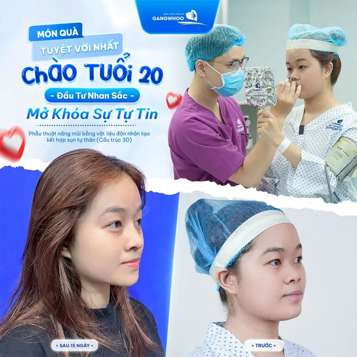 Nên Nâng Mũi Bọc Sụn Hay SLine? Các Ưu Và Nhược Điểm 4 Nâng mũi mở khóa phiên bản tự tin chào đón tuổi 20 đầy rạng rỡ