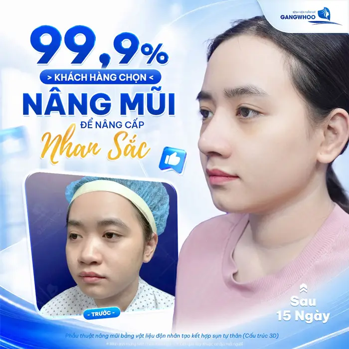 Khách hàng chọn nâng mũi để nâng cấp nhan và kết quả sau thực hiện gương mặt thay đổi đẹp vượt mong đợi