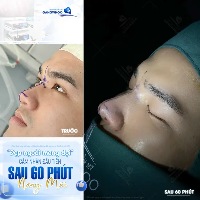 Cận cảnh sau 60 phút phẫu thuật nâng mũi đẹp ngoài mong đợi cho khách hàng 