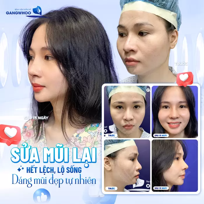 Nâng mũi sửa lại đầu mũi hết lộ, sống mũi hết đỏ khôi phục lại dáng mũi đẹp tự nhiên và hài hòa
