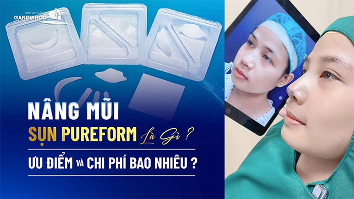 Nâng Mũi Sụn Pureform Là Gì? Ưu Điểm Và Chi Phí Bao Nhiêu? 1 Nâng Mũi Sụn Pureform