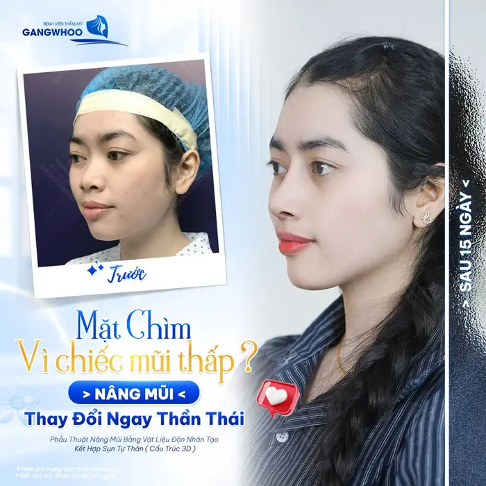 Nâng mũi thay đổi thần thái nâng tầm diện mạo thêm cuốn hút và đầy rạng rỡ