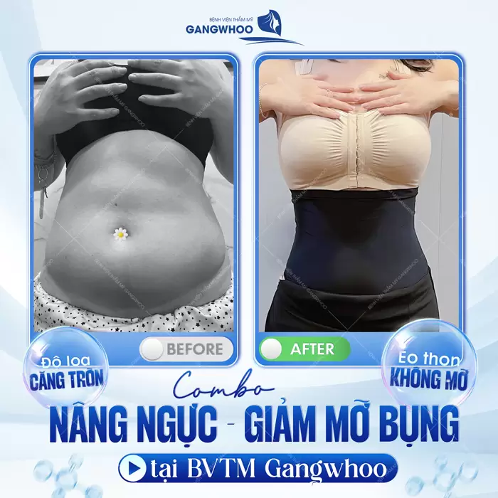 Nâng Ngực Bằng Mỡ Tự Thân: An Toàn Và Hiệu Quả 18 Kết hợp 2 trong 1 nâng ngực giảm mỡ khách hàng sở hữu vóc dáng cực nuột nà