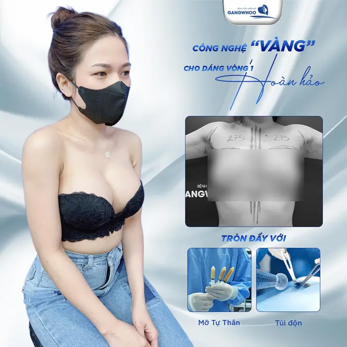 Nâng Ngực Bằng Mỡ Tự Thân: An Toàn Và Hiệu Quả 20 nâng ngực mỡ tự thân