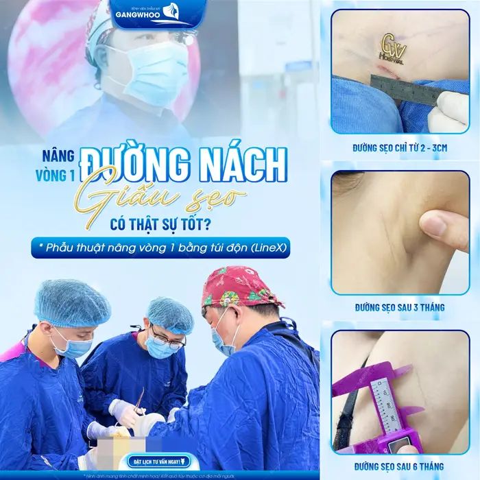 Nâng Ngực Nội Soi Đường Nách Là Gì? 2 Nâng vòng 1 đường nách giấu sẹo tinh tế sự cải thiện mờ dần theo thời gian
