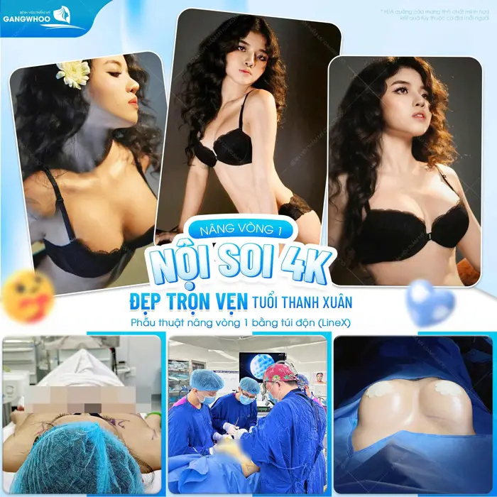 Nâng vòng 1 nội soi 4K đẹp trọn vẹn tuổi thanh phẫu sau phẫu thuật nâng vòng 1 bằng túi độn 