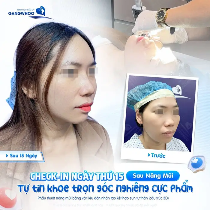 Check in ngày thứ 15 sau nâng mũi tự tin khoe trọn góc nghiêng cực phẩm không để lại sẹo xấu, sẹo lồi 