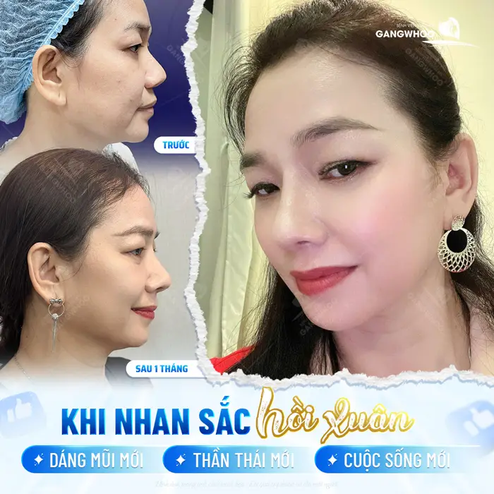 Nhan sắc hồi xuân, diện mạo xinh đẹp rạng rỡ đầy thần thái sau phẫu thuật