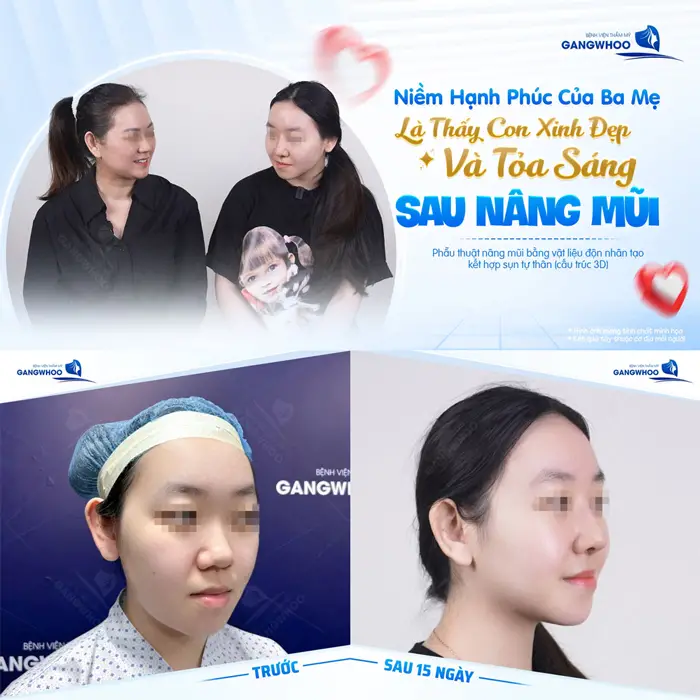 Niềm hạnh phúc của ba mẹ khi thấy sự xinh đẹp của con sau 15 ngày nâng mũi