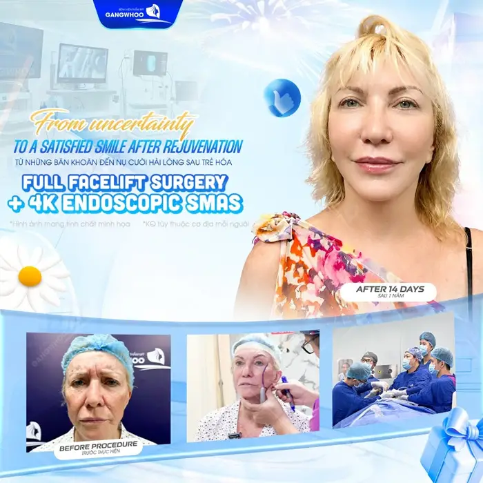 Từ những băn khoăn đến nụ cười hài lòng sau phẫu thuật căng da mặt toàn phần Smas nội soi 4K