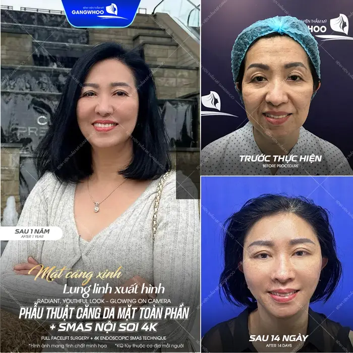 Mặt xinh tươi trẻ lung linh trước ống kính chỉ cần 1 lần thực hiện phẫu thuật căng da mặt nhan sắc đã hoàn toàn thăng hạng