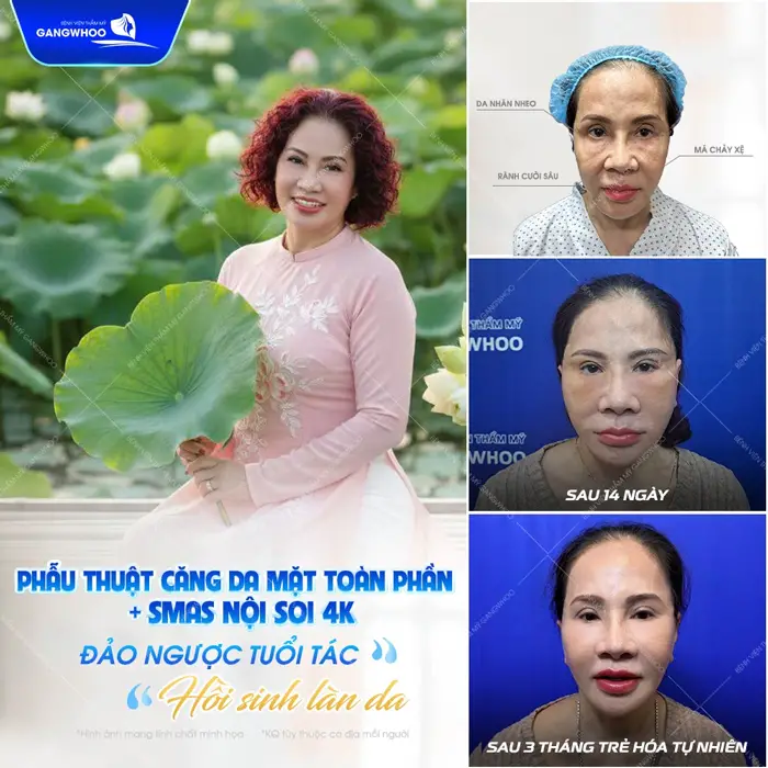 Phẫu thuật căng da mặt toàn phần Smas nội soi 4K đảo ngược tuổi tác hồi sinh làn da đẹp chuẩn 