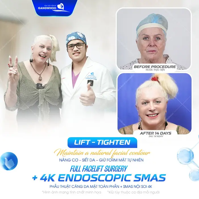 Phẫu thuật căng da mặt toàn phần Smas nội soi vi phẫu nâng cơ, siết da giữ form mặt tự nhiên và chuẩn đẹp dài lâu 