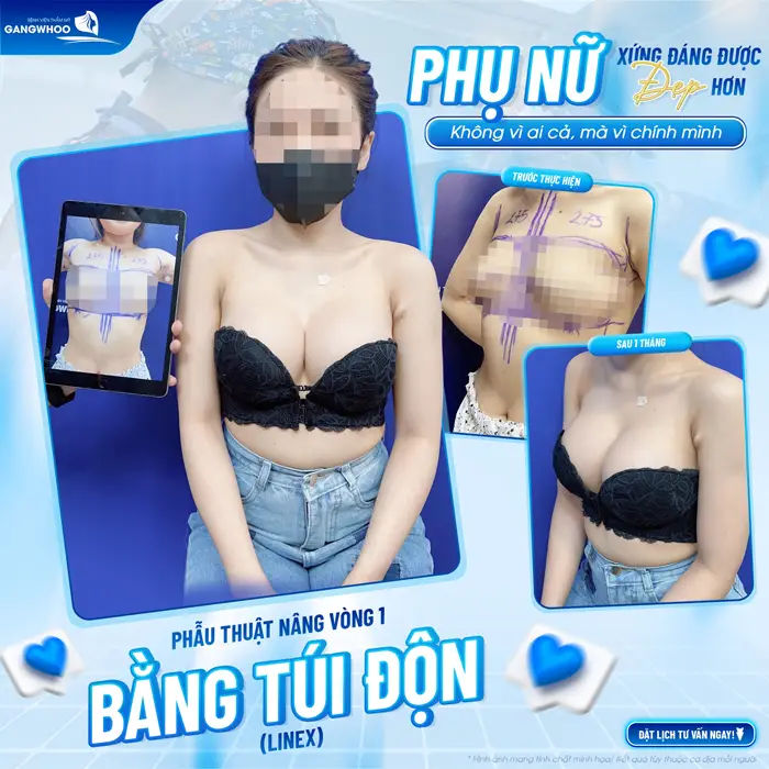 Phẫu thuật nâng vòng 1 bằng túi độn body đẹp quyến rũ tôn tạo vòng 1 xinh đẹp đầy cuốn hút