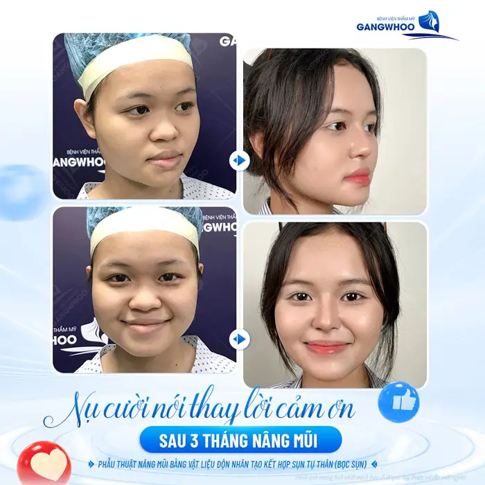 Sau 3 tháng nâng mũi mỉm cười hạnh phúc vì diện mạo mới quá xinh đẹp và hài hòa