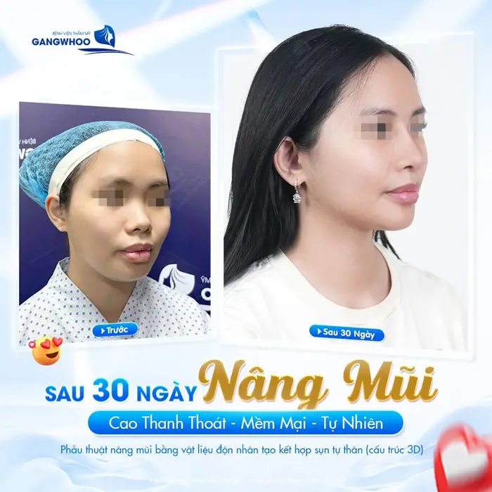 Sau 30 phút nâng mũi cao thanh thoát, mềm mại và đầy tự nhiên 