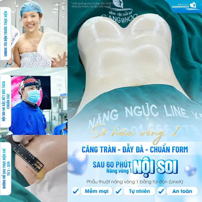 Sở hữu vòng 1 căng tràn, chuẩn form đẹp ngay sau 60 phút phẫu thuật 