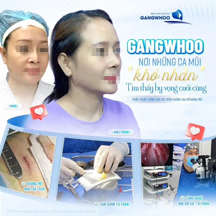 Khắc phục khuyết điểm mũi sau nâng kém hài hòa, không thanh thoát tại bệnh viện thẩm mỹ Gangwhoo 