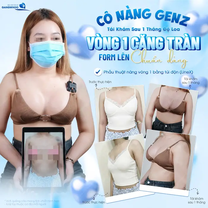 Cô nàng GenZ tái khám sau 1 tháng nâng vòng 1 đẹp chuẩn form, lên hình chuẩn dáng