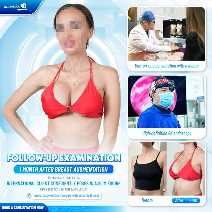 Phẫu thuật nâng cấp vòng 1 tại BVTM Gangwhoo vòng 1 đẹp quyến rũ và căng đầy chuẩn sắc vóc