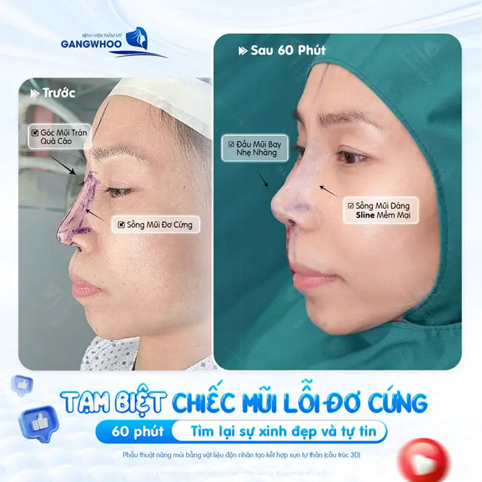 Tạm biệt chiếc mũi lỗi đơ cứng, sau 60 phút sửa lại đường nét gương mặt thêm hài hòa và cân đối 