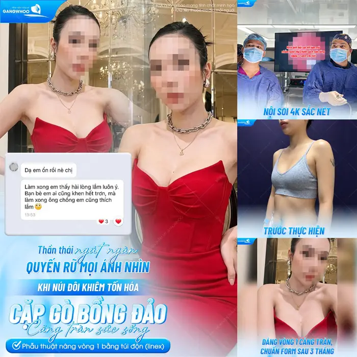Body quyến rũ, sắc vóc thăng hạng sau phẫu thuật nâng vòng 1 bằng công nghệ nội soi vi phẫu hiện đại 