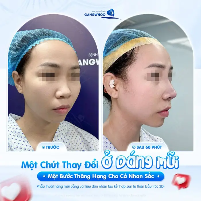 Nâng Mũi Bao Lâu Thì Lành? Cách Chăm Sóc Nhanh Lành 2 1 chút thay đổi nhỏ ở dáng mũi 1 bước cho nhan sắc thăng hạng