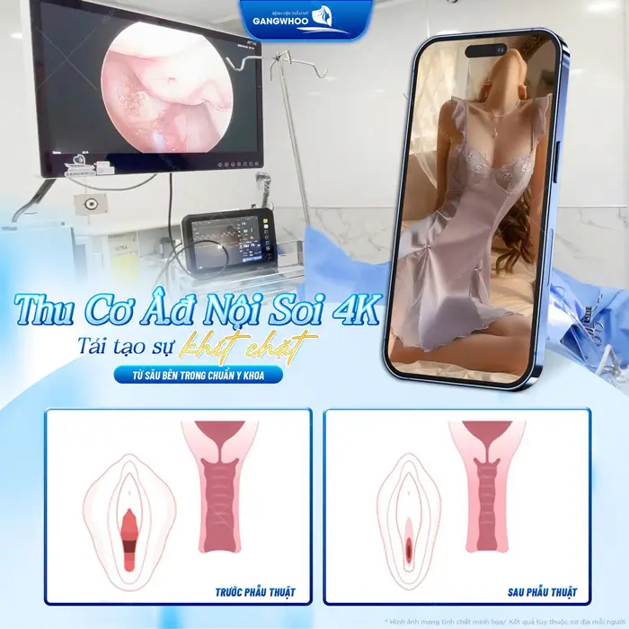 Thu Cơ Âm Đạo: "Cô Bé E Ấp" Cho Chàng Thăng Hoa 8 Thu cơ âm đạo 3 lớp tái tạo sự chặt chẽ từ sâu bên trong chuẩn y khoa và an toàn