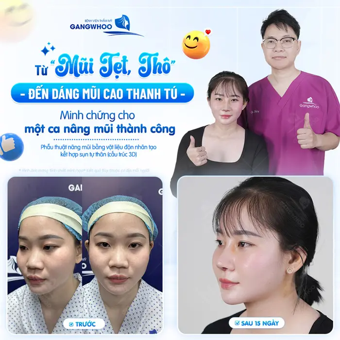 Từ mũi thô, thấp tẹt đến dáng mũi cao thanh thoát minh chứng cho 1 ca mũi thành công đẹp vượt ngoài mong đợi
