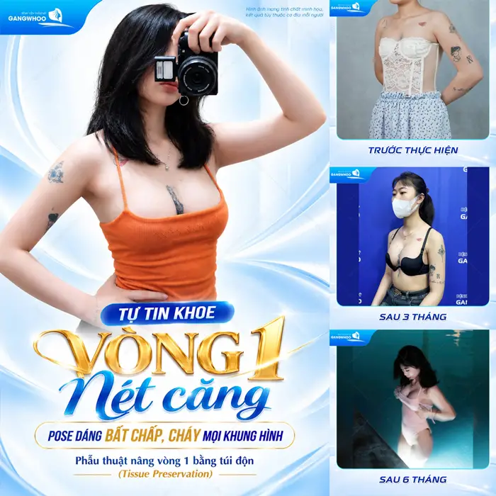 Nâng Ngực Nội Soi Đường Nách Là Gì? 3 Tự tin khoe vòng 1 nét căng Pose dáng cháy mọi khung hình sau nâng cấp vòng 1