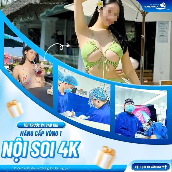 Nâng Ngực Nội Soi Đường Nách Là Gì? 4 Nâng vấp vòng 1 bằng túi độn nội soi 4K sự cải thiện đầy ngoạn mục sau thực hiện