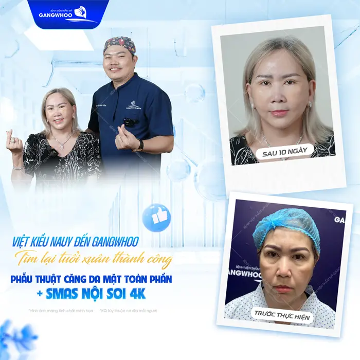 Việt Kiều từ Nauy đến Gangwhoo tìm lại tuổi xuân thành công sau 10 ngày phẫu thuật căng da mặt toàn phần