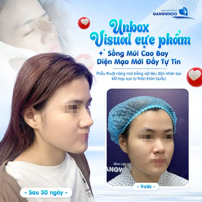 Nâng Mũi Có Được Vĩnh Viễn Không? Yếu Tố Ảnh Hưởng Độ Bền 2 Visual cực phẩm cho sống mũi cao bay diện mạo mới thăng hạng đầy tự tin sau 30 ngày đã hoàn toàn khác biệt