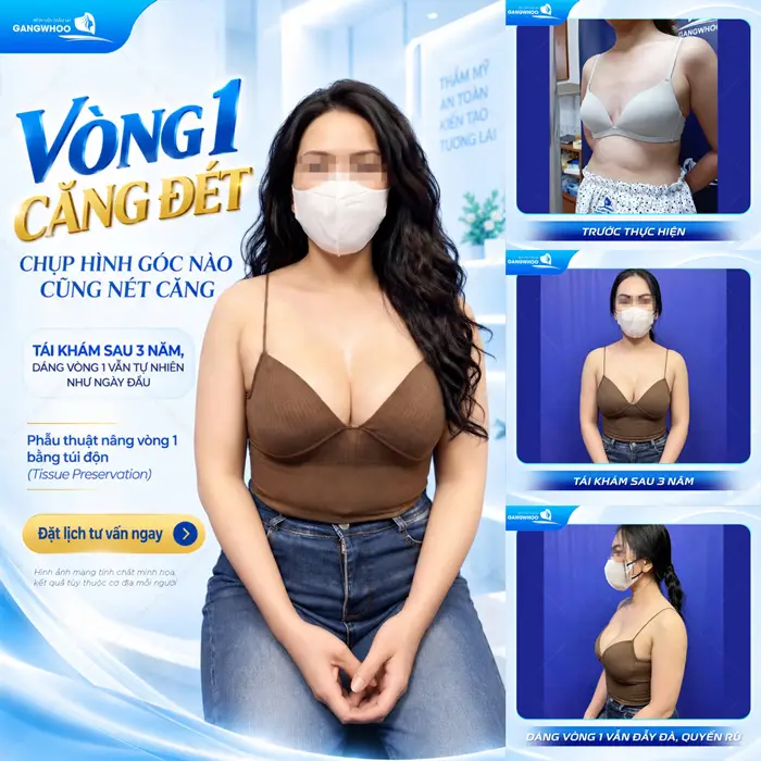 Vòng 1 căng đét chụp góc nào cũng đẹp sau 3 năm tái khám nâng vòng 1 đẹp xuất sắc mềm mại và tự nhiên