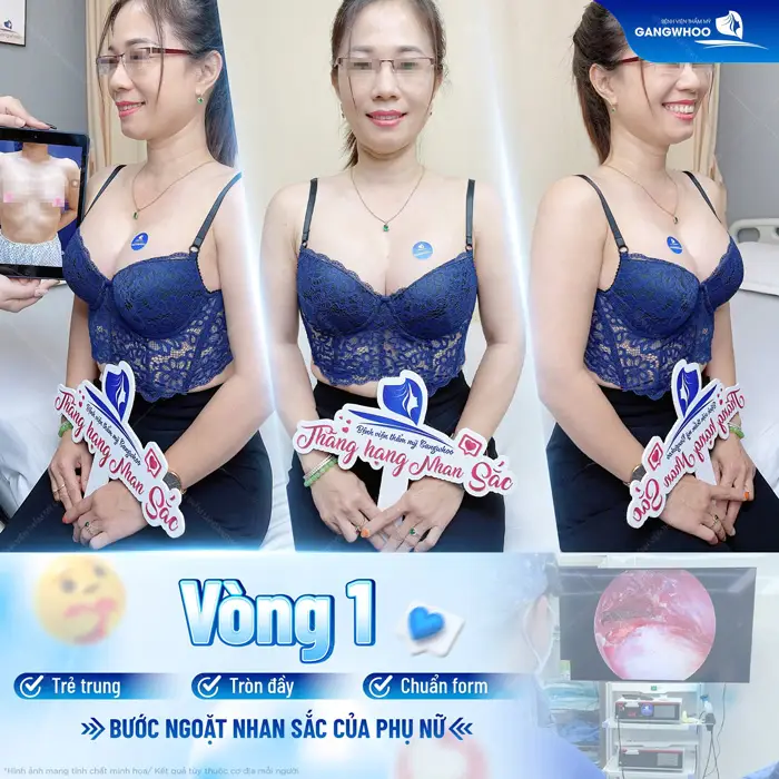 Nâng cấp vòng 1 bước ngoặt thay đổi nhan sắc của chị em phụ nữ